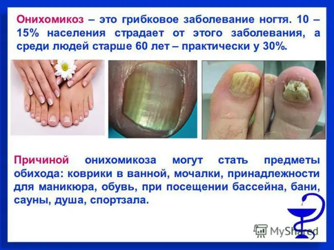 Лечение онихомикоза (грибка ногтей)