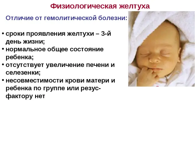 Лечение желтушки у новорожденных 