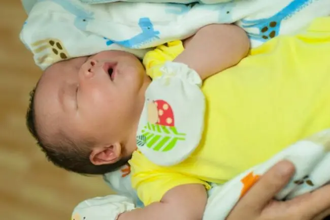 Признаки физиологической желтухи у новорожденных